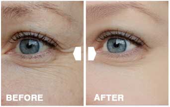 DermaSet Before After