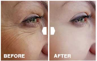 DermaSet Before After