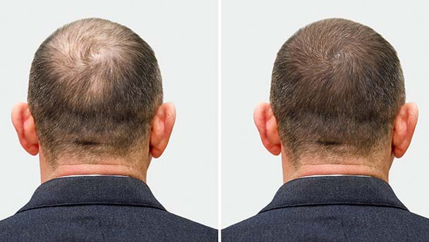 Before-After