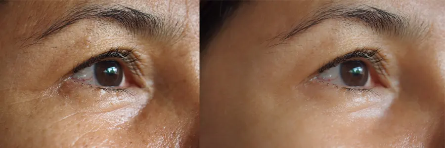 Before and After Using Wrinkare 3-In-1