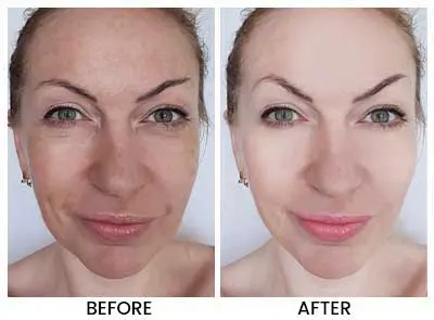 Dermal Repair Complex Before and After