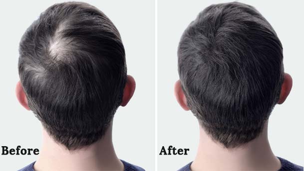 Before-After
