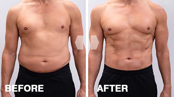 ketocharge-before-after-images