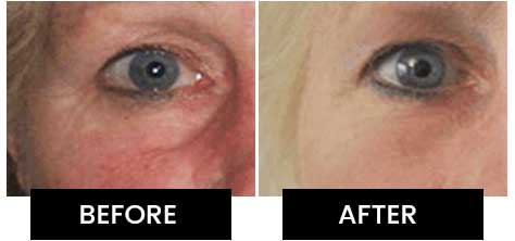 Kollagen Intensiv Before After