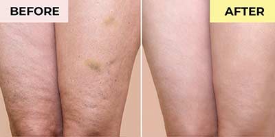 Life’s Butter Anti-Cellulite Cream Before and After Pictures