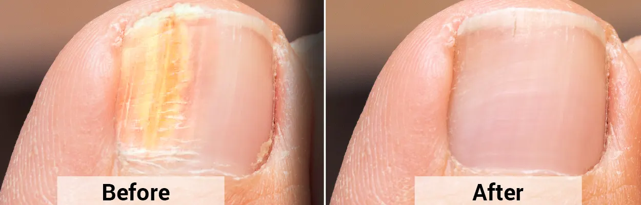 Metanail Serum Pro Before After Result