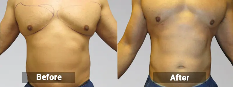 sonobello male surgery